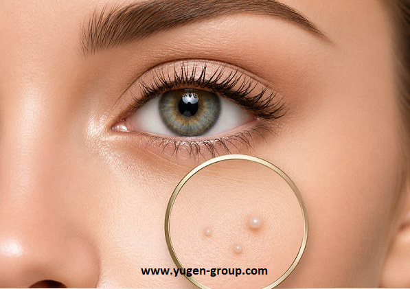 علت میلیا، روش‌های پیشگیری و ترکیباتی که ممکن است باعث ایجاد یا تشدید میلیا شوند